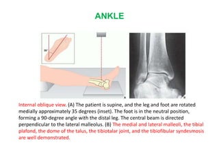 ANKLE
Internal oblique view. (A) The patient is supine, and the leg and foot are rotated
medially approximately 35 degrees (inset). The foot is in the neutral position,
forming a 90-degree angle with the distal leg. The central beam is directed
perpendicular to the lateral malleolus. (B) The medial and lateral malleoli, the tibial
plafond, the dome of the talus, the tibiotalar joint, and the tibiofibular syndesmosis
are well demonstrated.
 