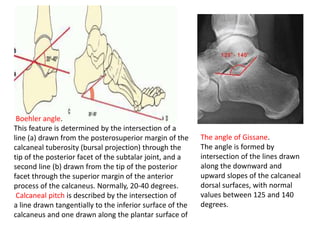 Boehler angle.
This feature is determined by the intersection of a
line (a) drawn from the posterosuperior margin of the
calcaneal tuberosity (bursal projection) through the
tip of the posterior facet of the subtalar joint, and a
second line (b) drawn from the tip of the posterior
facet through the superior margin of the anterior
process of the calcaneus. Normally, 20-40 degrees.
Calcaneal pitch is described by the intersection of
a line drawn tangentially to the inferior surface of the
calcaneus and one drawn along the plantar surface of
The angle of Gissane.
The angle is formed by
intersection of the lines drawn
along the downward and
upward slopes of the calcaneal
dorsal surfaces, with normal
values between 125 and 140
degrees.
 