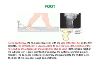 FOOT
Harris-Beath view. (A) The patient is erect, with the sole of the foot flat on the film
cassette. The central beam is usually angled 45 degrees toward the midline of the
heel, but 35 or 55 degrees of angulation may also be used. (B) the middle facet of
the subtalar joint is seen, oriented horizontally; the sustentaculum tali projects
medially. The posterior facet projects laterally and is parallel to the middle facet.
The body of the calcaneus is well demonstrated.
 