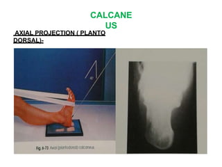 CALCANE
US
AXIAL PROJECTION ( PLANTO
DORSAL)-
 