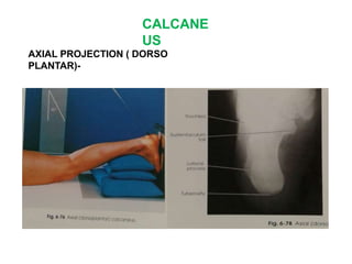 CALCANE
US
AXIAL PROJECTION ( DORSO
PLANTAR)-
 