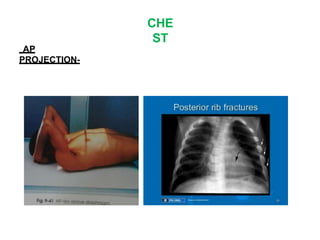 CHE
ST
AP
PROJECTION-
 