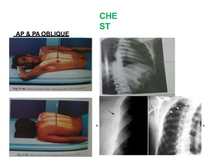 CHE
ST
AP & PA OBLIQUE
PROJECTION-
 