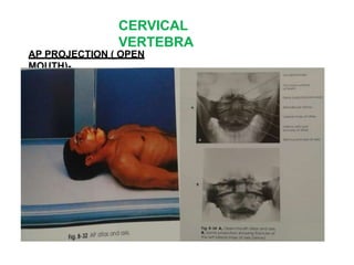 CERVICAL
VERTEBRA
AP PROJECTION ( OPEN
MOUTH)-
 