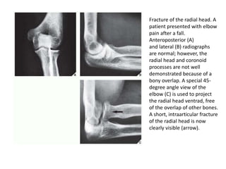 Fracture of the radial head. A
patient presented with elbow
pain after a fall.
Anteroposterior (A)
and lateral (B) radiographs
are normal; however, the
radial head and coronoid
processes are not well
demonstrated because of a
bony overlap. A special 45-
degree angle view of the
elbow (C) is used to project
the radial head ventrad, free
of the overlap of other bones.
A short, intraarticular fracture
of the radial head is now
clearly visible (arrow).
 