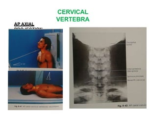 CERVICAL
VERTEBRA
AP AXIAL
PROJECTION-
 