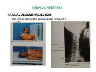 CERVICAL VERTEBRA
AP AXIAL OBLIQUE PROJECTION-
The image shows the intervertebral foramina &
pedicles.
 