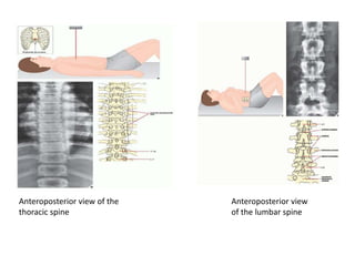 Anteroposterior view of the
thoracic spine
Anteroposterior view
of the lumbar spine
 