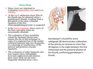 Stress Views
• Stress views are important in
evaluating ligamentous tears and joint
stability.
• In the hand, abduction-stress film of
the thumb may be obtained when a
gamekeeper's thumb, resulting from a
disruption of the ulnar collateral
ligament of the first
metacarpophalangeal joint, is suspected
• In the lower extremity, stress views of
the knee and ankle joints are
occasionally obtained.
• The evaluation of knee instability
caused by ligament injuries may
require the use of this technique in
cases of a suspected tear of the medial
collateral ligament and, less frequently,
in evaluating an insufficiency of the
anterior and posterior cruciate
ligaments.
• The evaluation of ankle ligaments also
may require stress radiography.
Inversion (adduction) and anterior-
draw stress films are the most
frequently obtained stress views .
Gamekeeper's thumbThe stress
radiograph (B) demonstrates subluxation
of the joint by an increase to more than
30 degrees in the angle between the first
metacarpal and the proximal phalanx of
the thumb, confirming gamekeeper's
thumb.
 