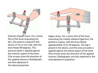 Anterior-drawer stress. For a stress
film of the knee evaluating the
ACL, the patient is placed in the
device on his or her side, with the
knee flexed 90 degrees. The
pressure plate is applied against
the anterior aspect of the knee.
(The arrows show the direction of
the applied stresses.) Radiographs
are then obtained in
the lateral projection.
Valgus stress. For a stress film of the knee
evaluating the medial collateral ligament, the
patient is supine, with the knee flexed
approximately 15 to 20 degrees. The leg is
placed in the device, and the pressure plate is
applied against the lateral aspect of the knee.
(The arrows show the direction of the applied
stresses.) Radiographs are then obtained in the
anteroposterior projection.
 