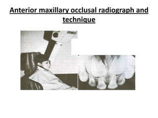 Anterior maxillary occlusal radiograph and
                technique
 