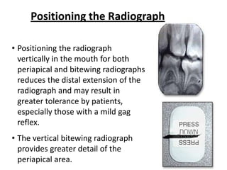 Positioning the Radiograph

• Positioning the radiograph
  vertically in the mouth for both
  periapical and bitewing radiographs
  reduces the distal extension of the
  radiograph and may result in
  greater tolerance by patients,
  especially those with a mild gag
  reflex.
• The vertical bitewing radiograph
  provides greater detail of the
  periapical area.
 