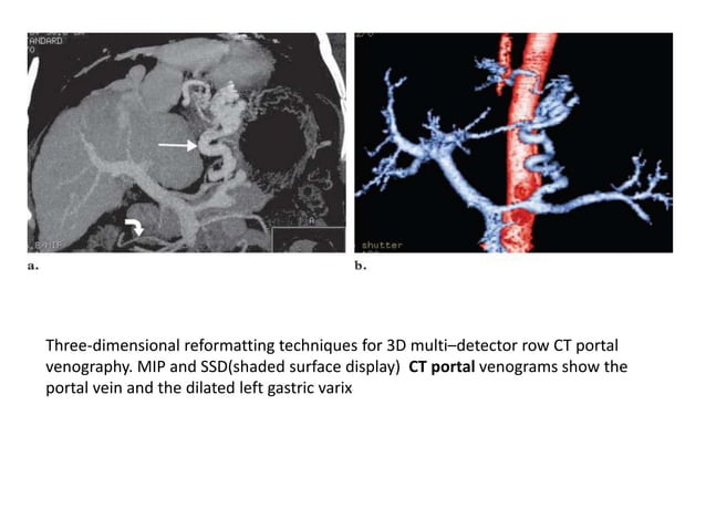 Radiology in portal hypertension | PPTX