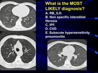 What is the MOST
LIKELY diagnosis?
A. RB_ILD.
B. Non specific interstitial
fibrosis
C. IPF.
D. CVD
E. Subacute hypersensitivity
pneumonitis.
 