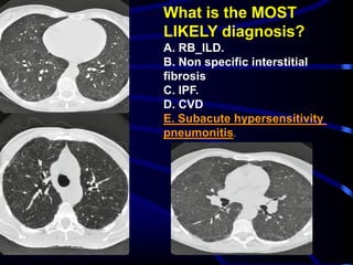 What is the MOST
LIKELY diagnosis?
A. RB_ILD.
B. Non specific interstitial
fibrosis
C. IPF.
D. CVD
hypersensitivitySubacuteE.
.pneumonitis
 