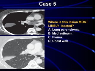 Case 5
Where is this lesion MOST
LIKELY located?
A. Lung parenchyma.
B. Mediastinum.
C. Pleura.
D. Chest wall..
 