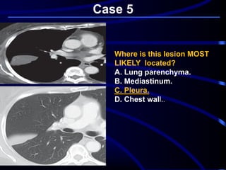 Case 5
Where is this lesion MOST
LIKELY located?
A. Lung parenchyma.
B. Mediastinum.
C. Pleura.
D. Chest wall..
 
