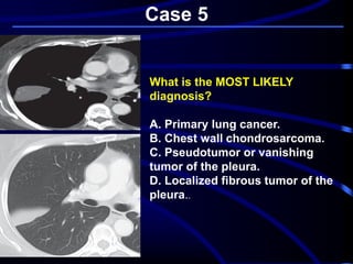 Case 5
What is the MOST LIKELY
diagnosis?
A. Primary lung cancer.
B. Chest wall chondrosarcoma.
C. Pseudotumor or vanishing
tumor of the pleura.
D. Localized fibrous tumor of the
pleura..
 