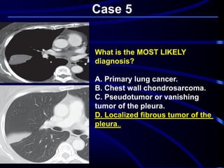 Case 5
What is the MOST LIKELY
diagnosis?
A. Primary lung cancer.
B. Chest wall chondrosarcoma.
C. Pseudotumor or vanishing
tumor of the pleura.
D. Localized fibrous tumor of the
..pleura
 