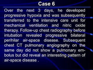 Case 6
Over the next 3 days, he developed
progressive hypoxia and was subsequently
transferred to the intensive care unit for
mechanical ventilation and nitric oxide
therapy. Follow-up chest radiography before
intubation revealed progressive bilateral
perihilar air-space disease. Subsequent
chest CT pulmonary angiography on the
same day did not show a pulmonary em-
bolus but did reveal an interesting pattern of
air-space disease .
 