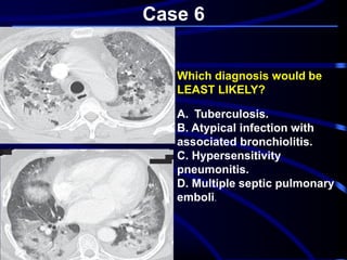 Case 6
Which diagnosis would be
LEAST LIKELY?
A. Tuberculosis.
B. Atypical infection with
associated bronchiolitis.
C. Hypersensitivity
pneumonitis.
D. Multiple septic pulmonary
emboli.
 
