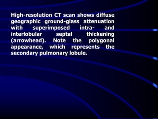 High-resolution CT scan shows diffuse
geographic ground-glass attenuation
with superimposed intra- and
interlobular septal thickening
(arrowhead). Note the polygonal
appearance, which represents the
secondary pulmonary lobule.
 