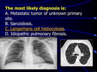 The most likely diagnosis is:
A. Metastatic tumor of unknown primary
site.
B. Sarcoidosis.
C. Langerhans cell histiocytosis.
D. Idiopathic pulmonary fibrosis.
 