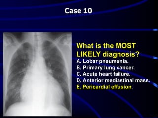 Case 10
What is the MOST
LIKELY diagnosis?
A. Lobar pneumonia.
B. Primary lung cancer.
C. Acute heart failure.
D. Anterior mediastinal mass.
.E. Pericardial effusion
 