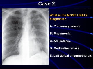 Case 2
What is the MOST LIKELY
diagnosis?
A. Pulmonary edema.
B. Pneumonia.
C. Atelectasis.
D. Mediastinal mass.
E. Left apical pneumothorax.
 