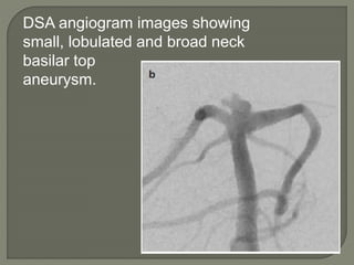 Radiology intervetion neuro | PPTX
