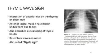 Triangular Sign Chest RADIOLOGY LOT CLASS T-Z SERIES in pulmonology MGMCRI | PPTX