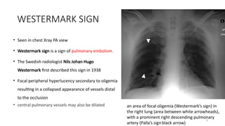 Westerback Sign Radiology lot class V,W,Y series in mgmcri | PPTX