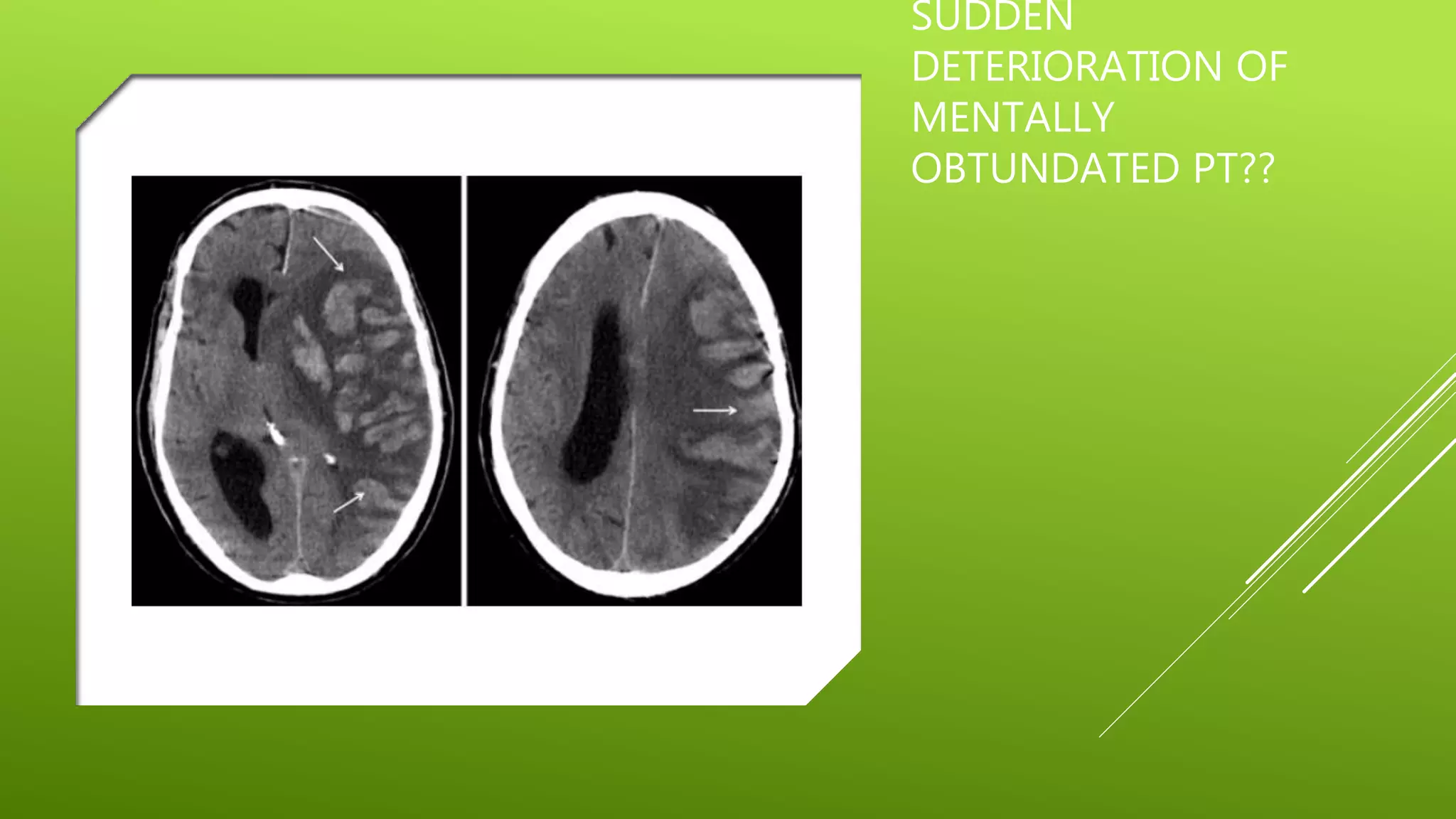 SUDDEN
DETERIORATION OF
MENTALLY
OBTUNDATED PT??
 