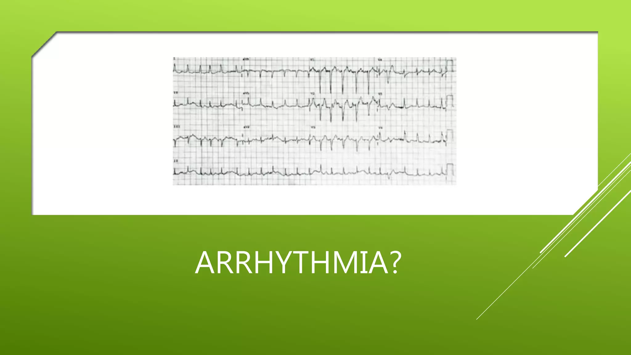 ARRHYTHMIA?
 