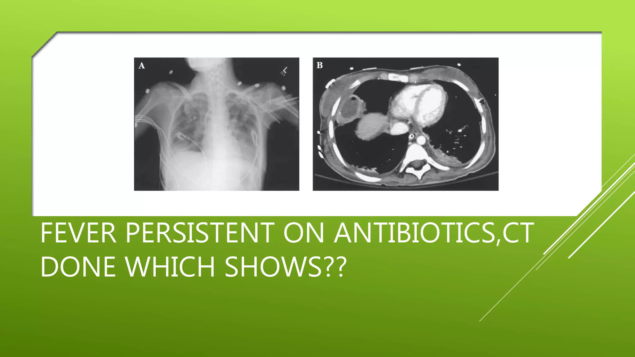 FEVER PERSISTENT ON ANTIBIOTICS,CT
DONE WHICH SHOWS??
 