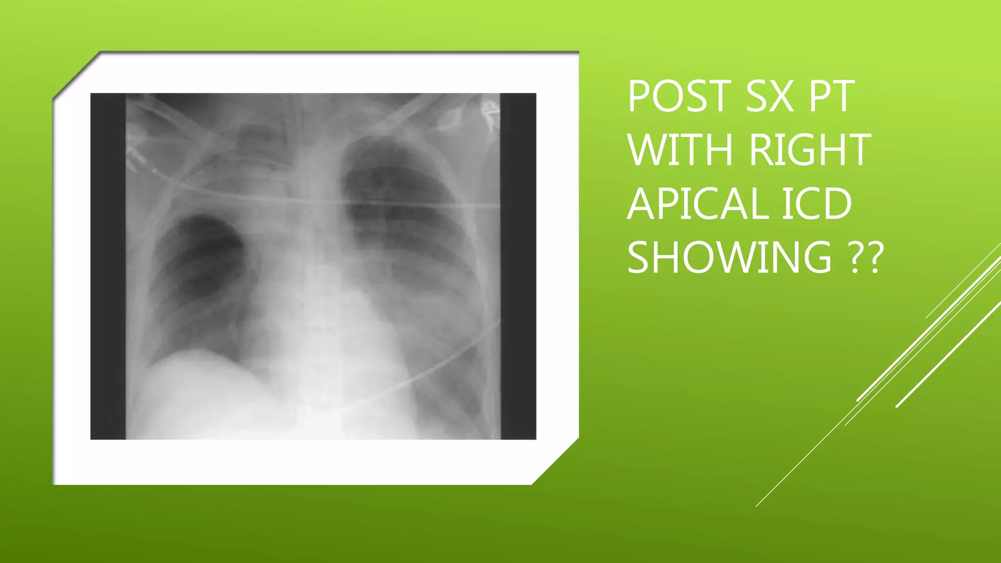 POST SX PT
WITH RIGHT
APICAL ICD
SHOWING ??
 