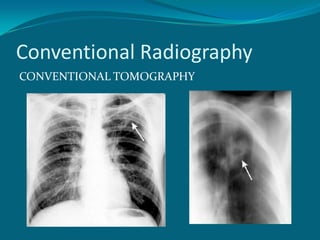Conventional Radiography
CONVENTIONAL TOMOGRAPHY
 