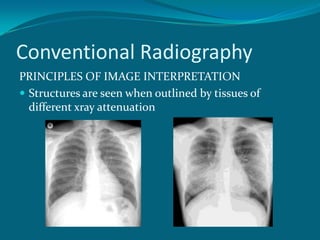 Conventional Radiography
PRINCIPLES OF IMAGE INTERPRETATION
 Structures are seen when outlined by tissues of
  different xray attenuation
 
