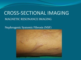 CROSS-SECTIONAL IMAGING
MAGNETIC RESONANCE IMAGING

Nephrogenic Systemic Fibrosis (NSF)
 