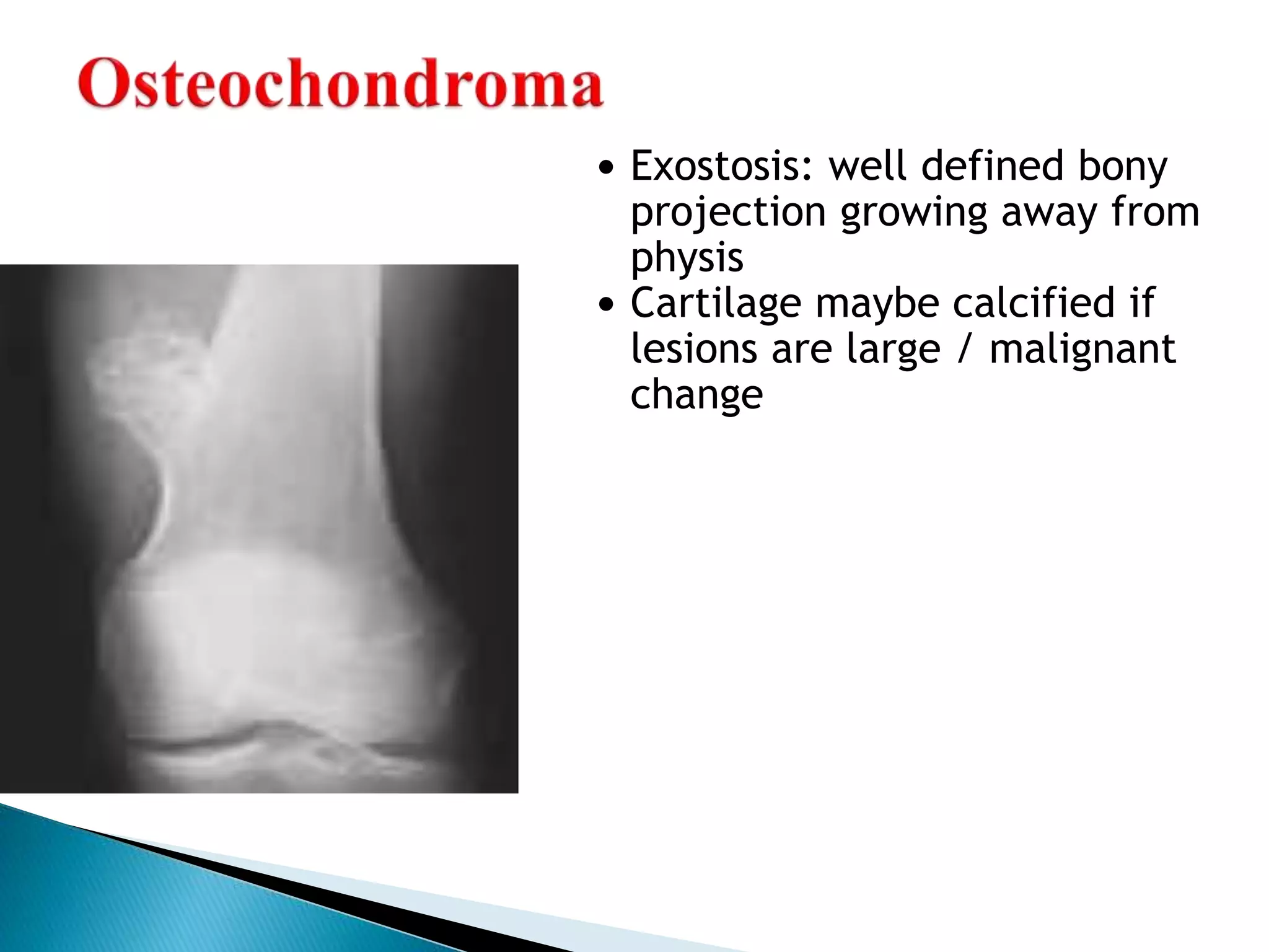  Exostosis: well defined bony
projection growing away from
physis
 Cartilage maybe calcified if
lesions are large / malignant
change
 