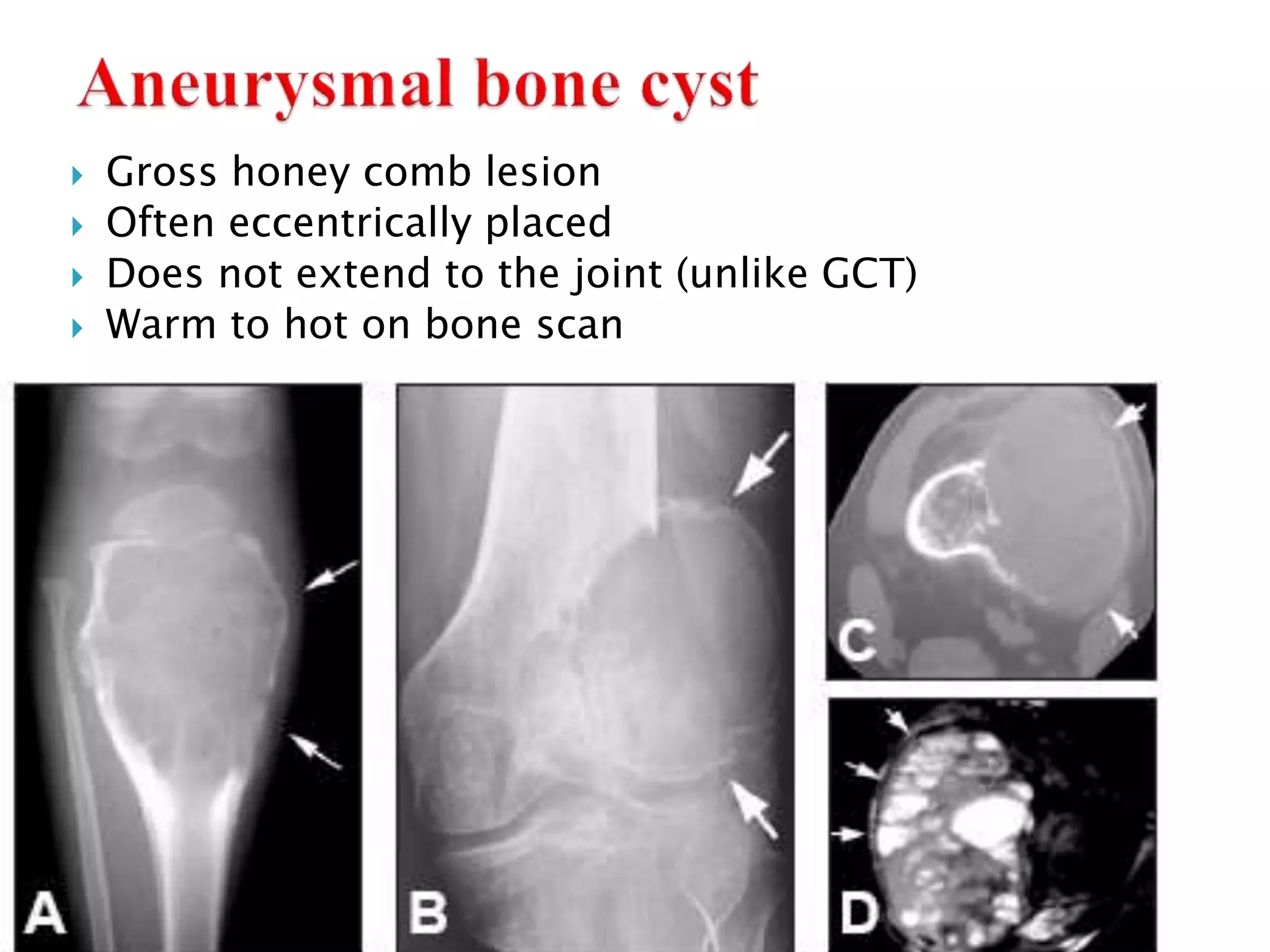  Gross honey comb lesion
 Often eccentrically placed
 Does not extend to the joint (unlike GCT)
 Warm to hot on bone scan
 