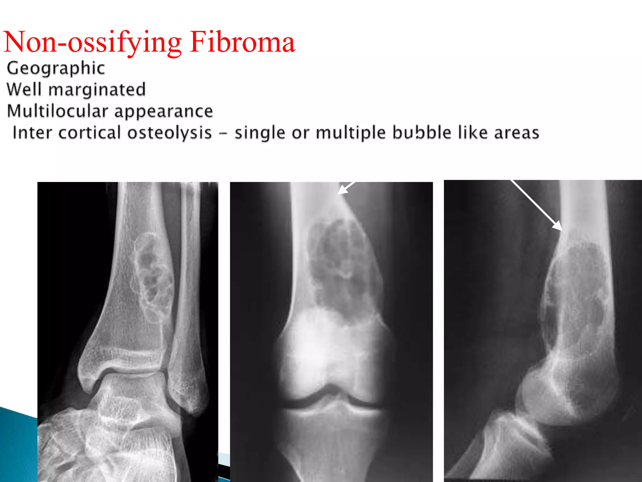 Non-ossifying Fibroma
 