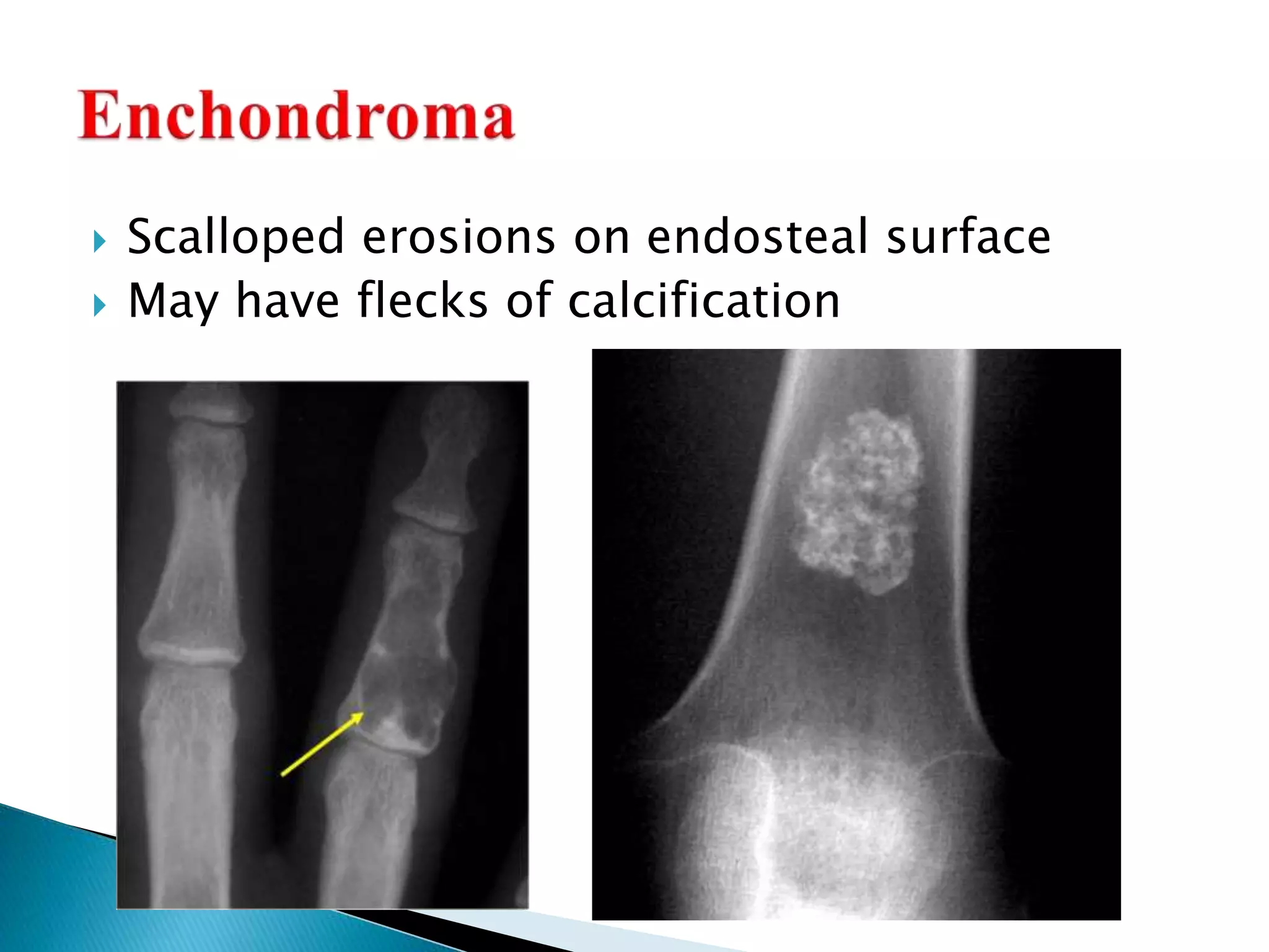  Scalloped erosions on endosteal surface
 May have flecks of calcification
 