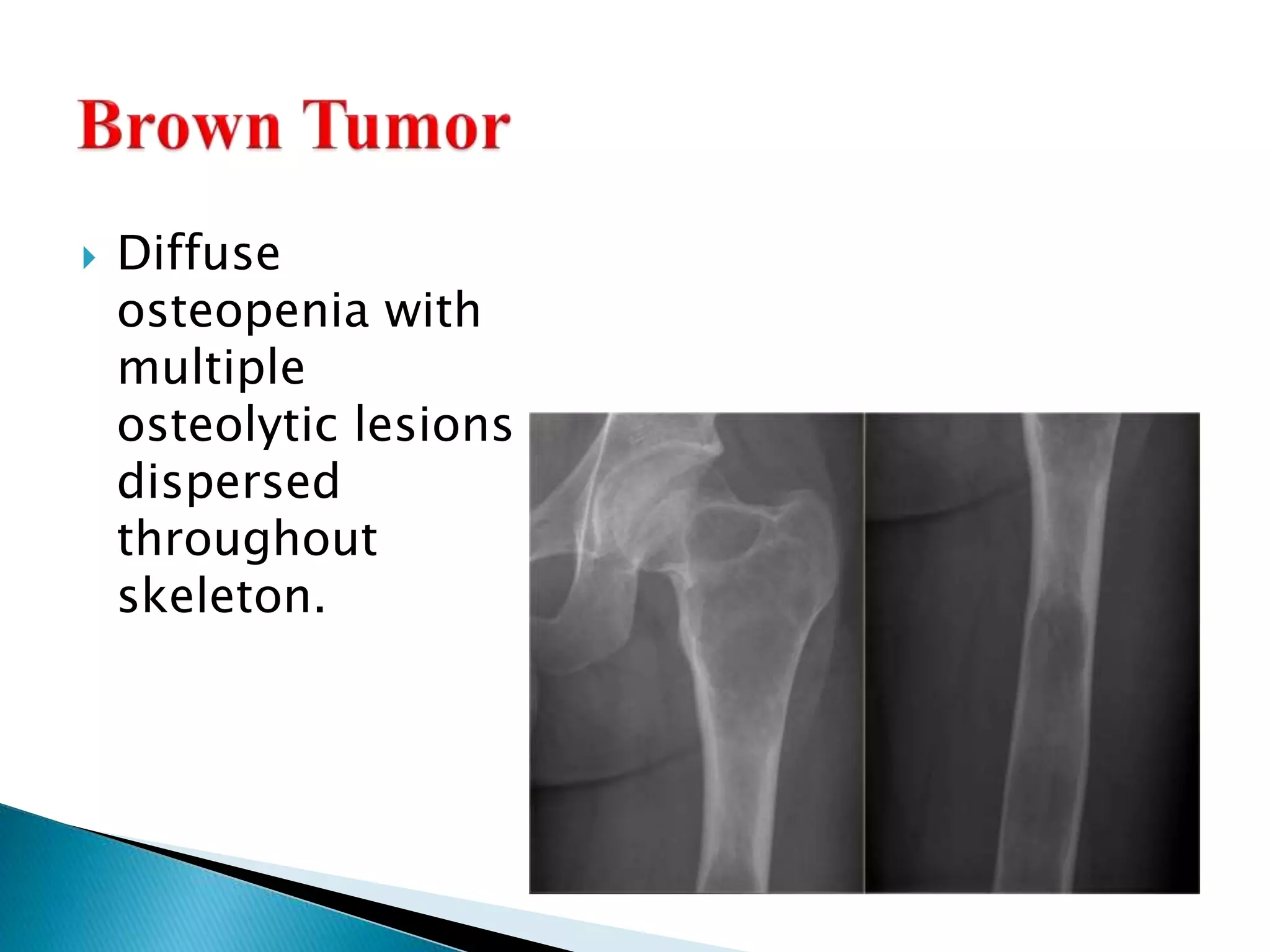  Diffuse
osteopenia with
multiple
osteolytic lesions
dispersed
throughout
skeleton.
 