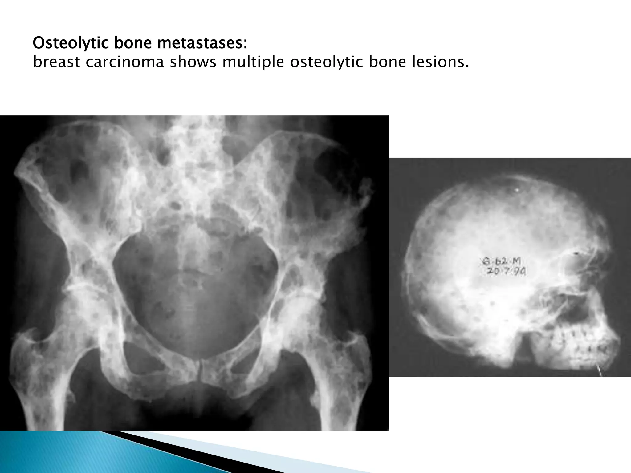 Osteolytic bone metastases:
breast carcinoma shows multiple osteolytic bone lesions.
 