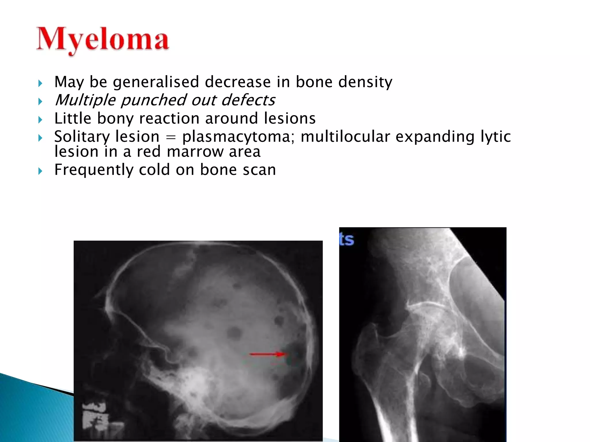  May be generalised decrease in bone density
 Multiple punched out defects
 Little bony reaction around lesions
 Solitary lesion = plasmacytoma; multilocular expanding lytic
lesion in a red marrow area
 Frequently cold on bone scan
 