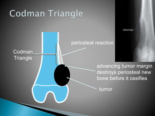 Radiology of Bone Tumours | PPTX