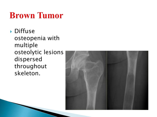 Radiology of Bone Tumours | PPTX