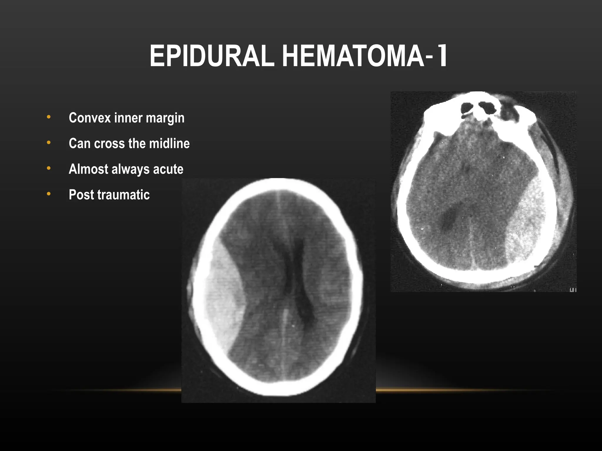 Radiological anatomy of Brain and stroke imaging.ppt