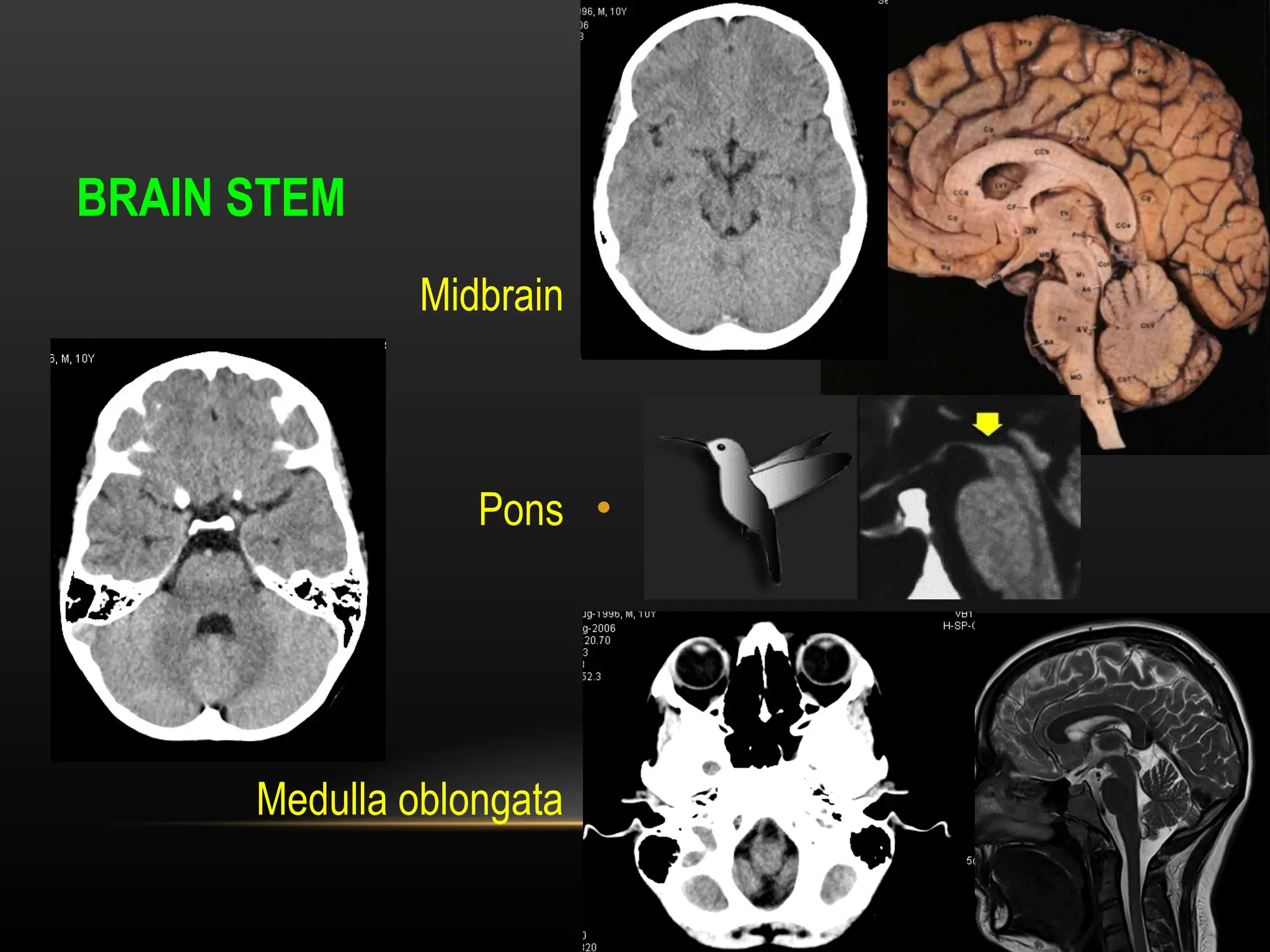Radiological anatomy of Brain and stroke imaging.ppt